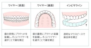 八重歯の全体矯正の表1